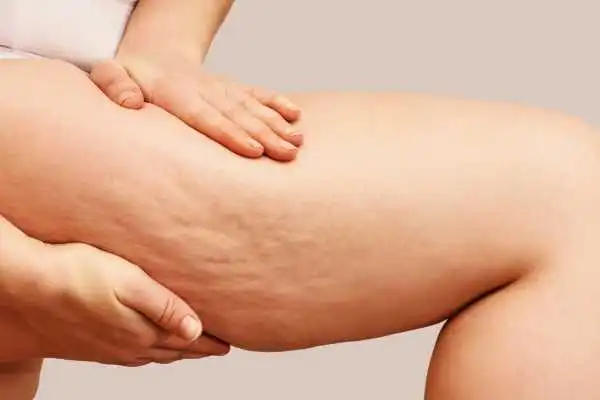 Image of woman showing leg with cellulite Colchester