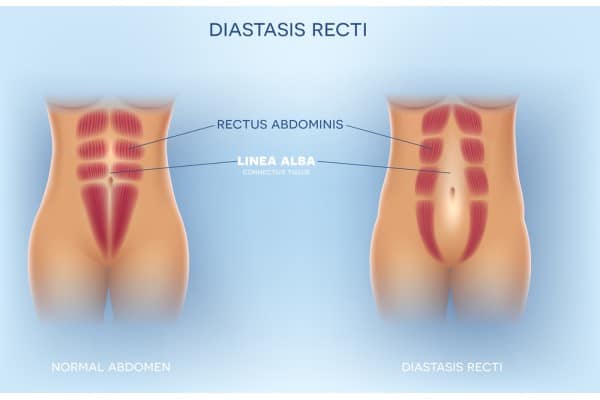 What Non-Surgical Options Are Available for Diastasis Recti Colchester?