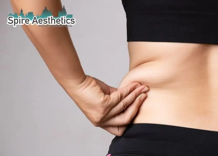 Image of woman pinching fat on their hips Colchester. Fat Freezing treatment