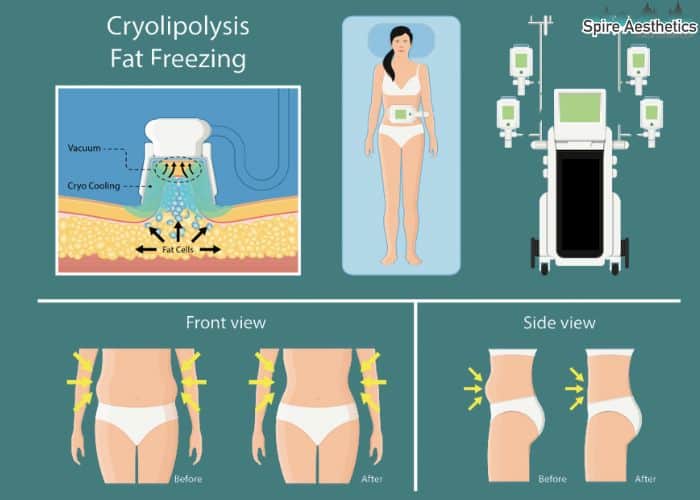 Image of diet and fat freezing combined for best results for Spire Aesthetics Colchester