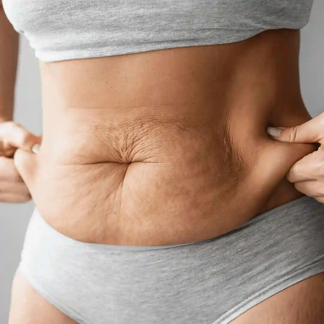 Is It Normal to Have Loose Skin After Pregnancy Colchester?