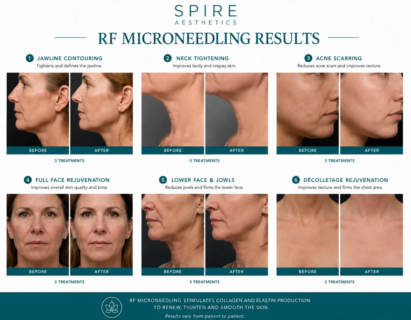 RF Microneedling Skin tightening Colchester results