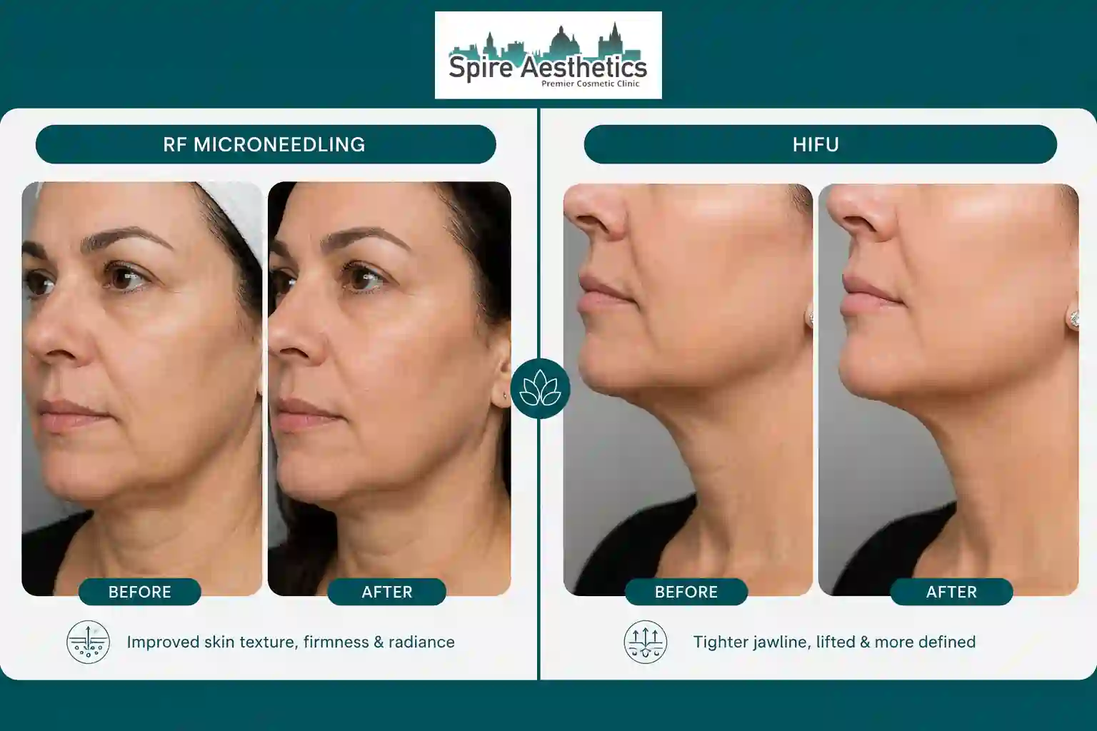 Can RF Microneedling and HIFU Be Combined Colchester?