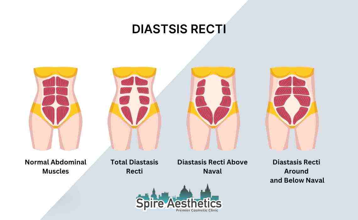 Is Non-Surgical Diastasis Recti Treatment Right for You? Common Concerns Answered Colchester
